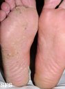 Fungal Foot